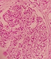 Neurotoxoplasmosios After Rituximab Therapy in Diffused Proliferative Glomerulonephritis Patient