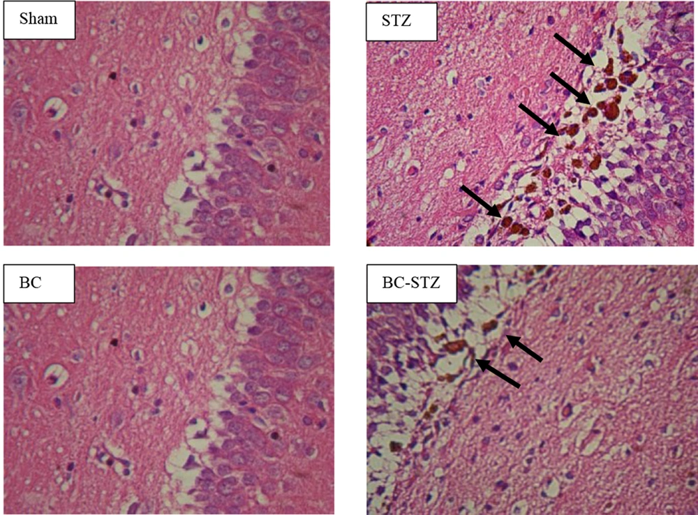 Comparison of Aβ plaques in the hippocampal DG region of the four main groups (H&E staining, × 400): Sham group, STZ group, BC group, and BC-STZ group. Comparison of Aβ plaques in the hippocampal DG region of the four main groups (H&E staining, × 400): Sham group, STZ group, BC group, and BC-STZ group.