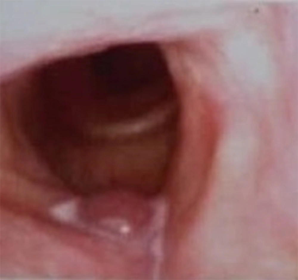 Video laryngoscopic view of a cyst in the right false vocal cord of a 61-year-old man Video laryngoscopic view of a cyst in the right false vocal cord of a 61-year-old man