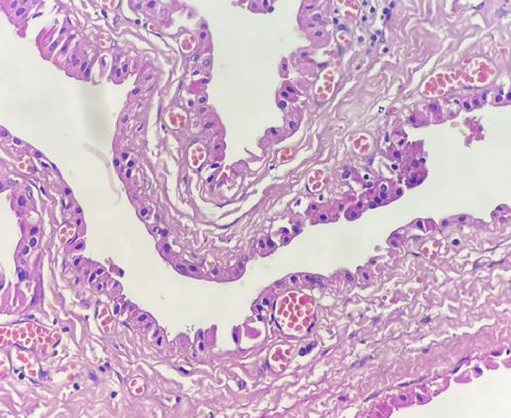 The cyst lining by bland oncocytic columnar cells (H&E, 400×) The cyst lining by bland oncocytic columnar cells (H&E, 400×)