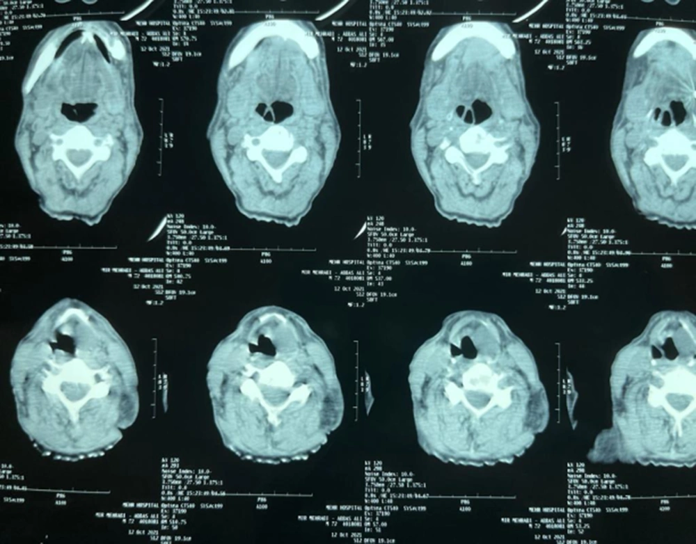Neck CT scan without contrast Neck CT scan without contrast
