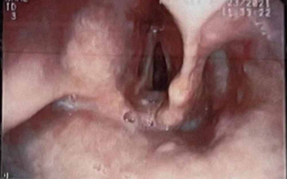 Video laryngoscopic view Video laryngoscopic view