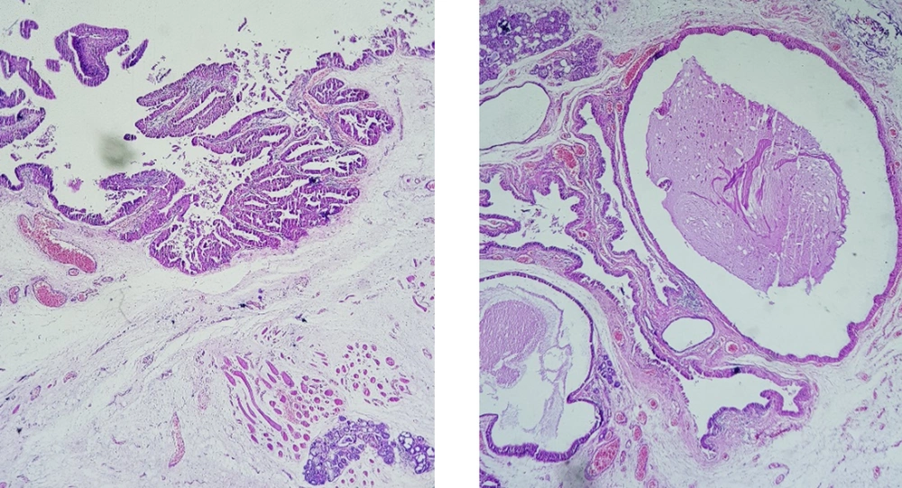 The microscopic view shows acystic structure with papillary growth lined by bland oncocytic cells (H&E, 100×). The microscopic view shows acystic structure with papillary growth lined by bland oncocytic cells (H&E, 100×).