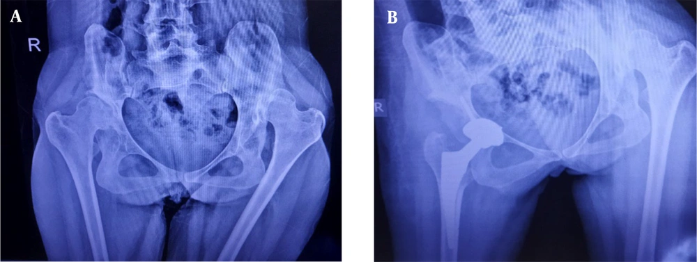 Radiography of a patient with bilateral developmental dysplasia of the hip before and after cementless total hip arthroplasty without subtrochanteric shortening osteotomy. Radiography of a patient with bilateral developmental dysplasia of the hip before and after cementless total hip arthroplasty without subtrochanteric shortening osteotomy.