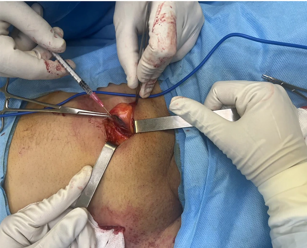 Papaverine injection Papaverine injection