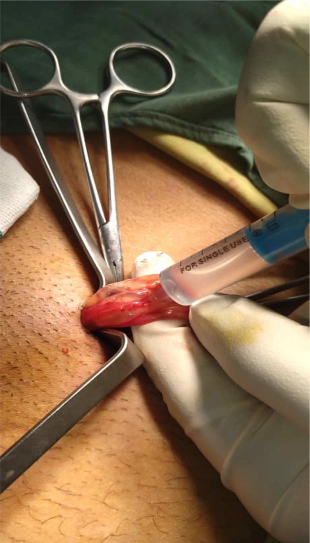 Hydro dissection and papaverine injection Hydro dissection and papaverine injection