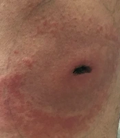 Cutaneous Necrosis After Suspected Hemiscorpius lepturus Sting or Loxosceles rufescens Bite: A Diagnostic and Management Consideration