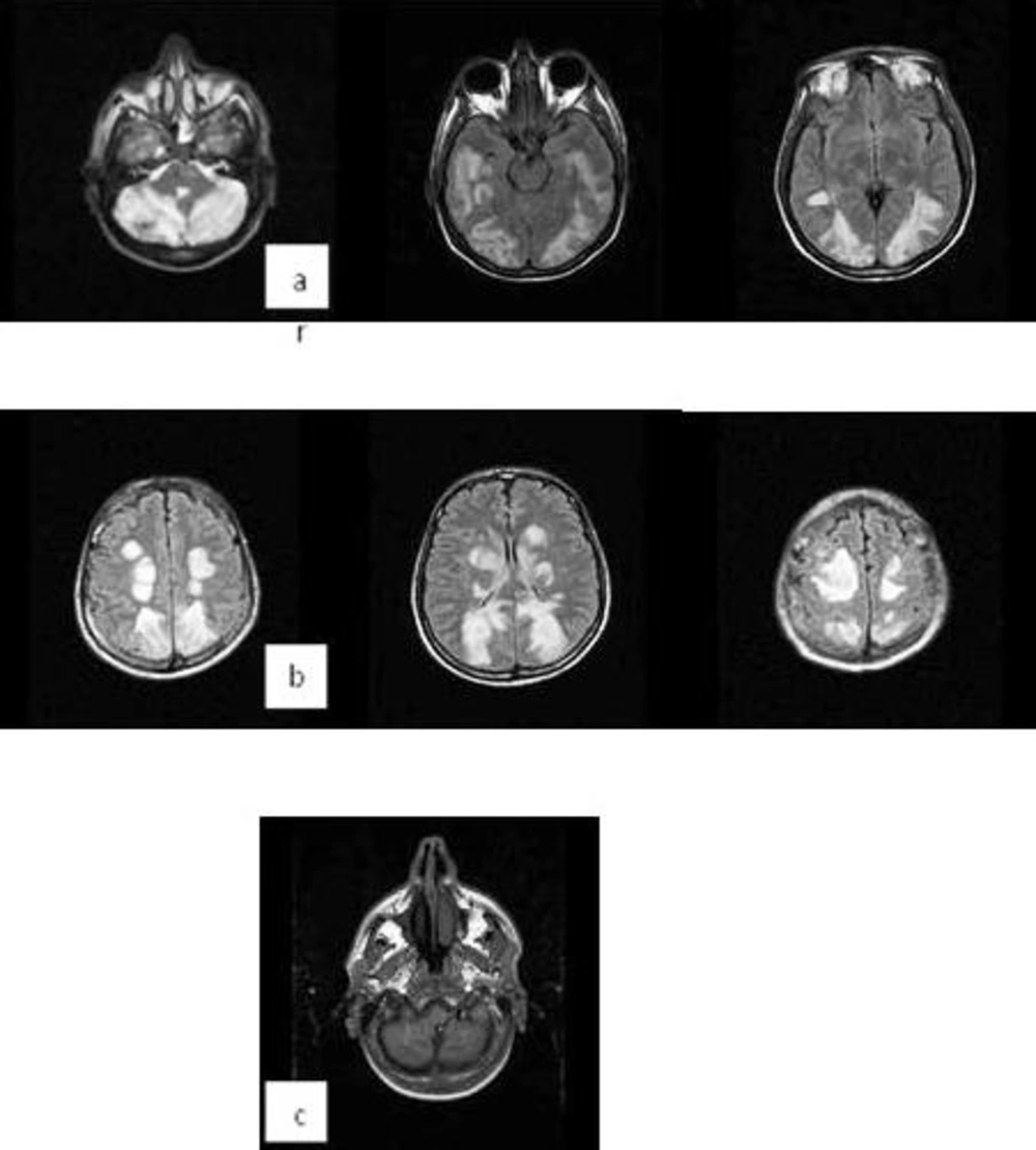 Bilateral Symmetrical Involvement of the Cerebellum Hemispheres (Temporal Lobes, Basal Ganglias, Both Thalamus, Parietal Watershed Zones and Occipital Lobes) (a, b). There are also Hemorrhagic Zones in the Cerebellum (c) Bilateral Symmetrical Involvement of the Cerebellum Hemispheres (Temporal Lobes, Basal Ganglias, Both Thalamus, Parietal Watershed Zones and Occipital Lobes) (a, b). There are also Hemorrhagic Zones in the Cerebellum (c)