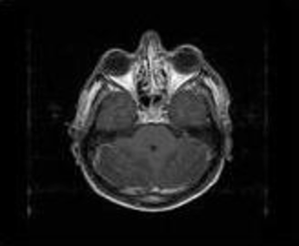 Bilateral Patchy Enhancement in the Cerebellum Hemispheres Bilateral Patchy Enhancement in the Cerebellum Hemispheres