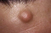 Cover image of the article: Comparison of the Surgical Outcomes of Minimal Excision and Elliptical Excision Techniques in Treating Epidermal Inclusion Cysts: A Prospective Randomized Study