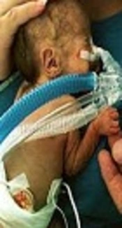 Comparing the Effect of Inhaler N-Acetyl Cysteine and Intravenous Dexamethasone on Respiratory Distress Syndrome in Premature Infants: A Randomized Clinical Trial