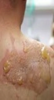 Study of Pre-hospital Emergency Care Assessment on Burned Patients Referred to Hospitals in Tabriz, Northwest Iran