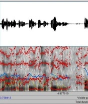 Speech Therapy (Rehabilitation Therapy) in Foreign Accent Syndrome in a Turkish Patient: A Case Report