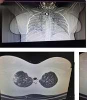 Successful Treatment of Pregnant Women with Coronavirus Disease While Maintaining Fetal Health: A Case Report