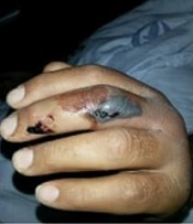 Snakebites on Distal Extremities; Three Years of Experiences