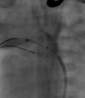 A Case Report of Embolized Stent and Rashkind Septostomy that Suffer Hemolysis Due to Stent in 2-Days Neonate with Pulmonary Atresia and Single Ventricle