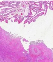 Tubo-Ovarian Abscess Following Normal Vaginal Delivery: A Case Report