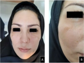 Cover image of the article: Revitalizing Your Skin: The Power of Microneedling with PRP for Pigmentation Reduction