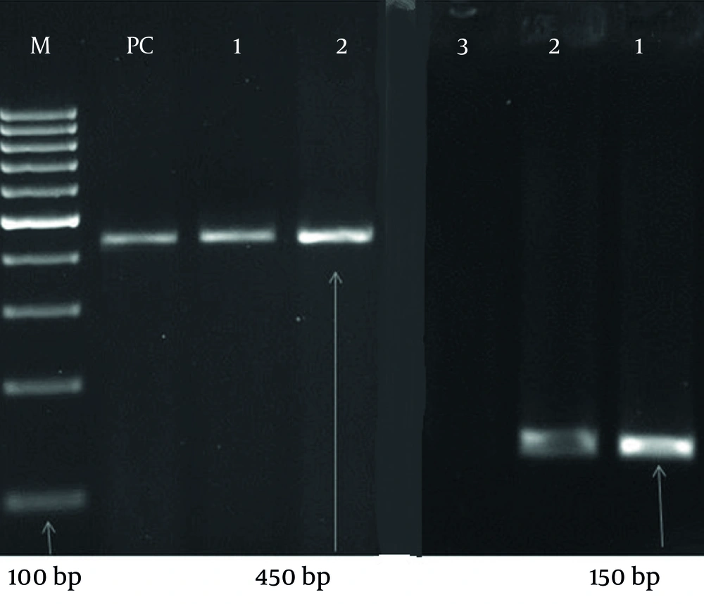 PCR detection of the human papillomavirus (HPV) genome in 290 samples using specific primers GP5+/6+ and MY09/11. Among the samples, 216 (74.5%) tested positive, while 74 (25.5%) were negative. The negative control well showed no bands, indicating no contamination, whereas the positive control well showed bands at 450 bp and 180 bp, confirming the accuracy of the PCR assay. PCR detection of the human papillomavirus (HPV) genome in 290 samples using specific primers GP5+/6+ and MY09/11. Among the samples, 216 (74.5%) tested positive, while 74 (25.5%) were negative. The negative control well showed no bands, indicating no contamination, whereas the positive control well showed bands at 450 bp and 180 bp, confirming the accuracy of the PCR assay.