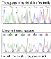 Investigating OPTN Gene Mutations of Low Vision (Glaucoma) in Two Khuzestan Families by WES Method