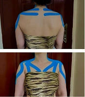 Immediate Effects of Myofascial Release and Kinesio Taping on Shoulder Posture and Range of Motion in Women with Rounded Shoulder Posture