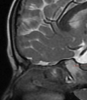 Dimensions of the Pituitary Gland in 2- to 18-Year-Old Iranians: A Magnetic Resonance Imaging Assessment