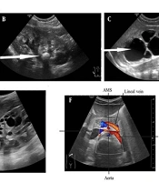 A Study of Ultrasonographic Findings in Children with Microscopic Hematuria in Zahedan