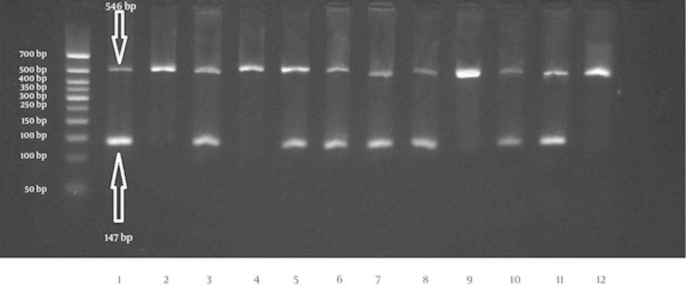 Schematic representation of the agarose gel electrophoresis for the rs5985 polymorphism in F13A1 gene. The first wells of each two well are related to the normal primer for allele Val (G) and the second one is for the mutant primer for allele Leu (T). Wells 1/2, 3/4, 11/12 show the wild type homozygote genotype (GG; Val/Val). The heterozygote genotype is seen in 5/6 and 7/8 wells and the wells 9/10 are related to mutant homozygote individual (TT; Leu/Leu). The first well from the left is the 50 bp size marker. Schematic representation of the agarose gel electrophoresis for the rs5985 polymorphism in F13A1 gene. The first wells of each two well are related to the normal primer for allele Val (G) and the second one is for the mutant primer for allele Leu (T). Wells 1/2, 3/4, 11/12 show the wild type homozygote genotype (GG; Val/Val). The heterozygote genotype is seen in 5/6 and 7/8 wells and the wells 9/10 are related to mutant homozygote individual (TT; Leu/Leu). The first well from the left is the 50 bp size marker.
