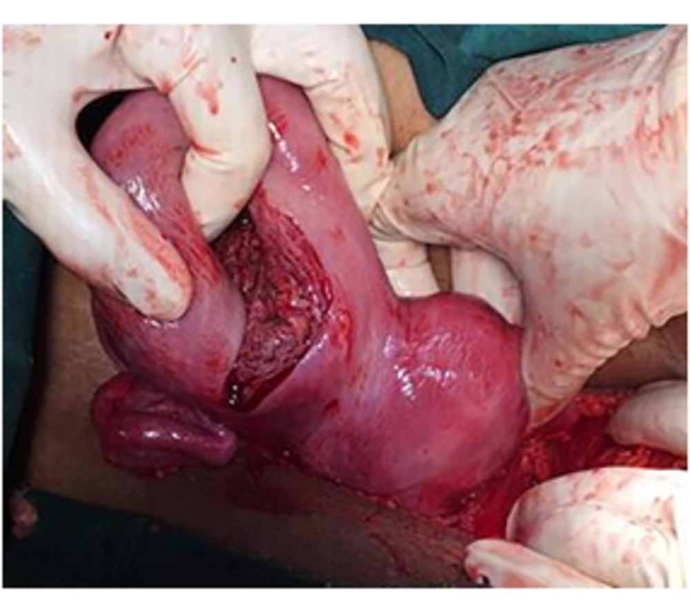 Rudimentary horn pregnancy on the right side Rudimentary horn pregnancy on the right side
