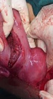 A Case of Rudimentary Horn Pregnancy Diagnosed After Failed Attempts at Pregnancy Termination