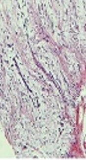 A Case of Oral Focal Mucinosis