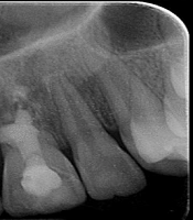Cover image of the article: Delayed Replantation of Avulsed Teeth: A Case Report